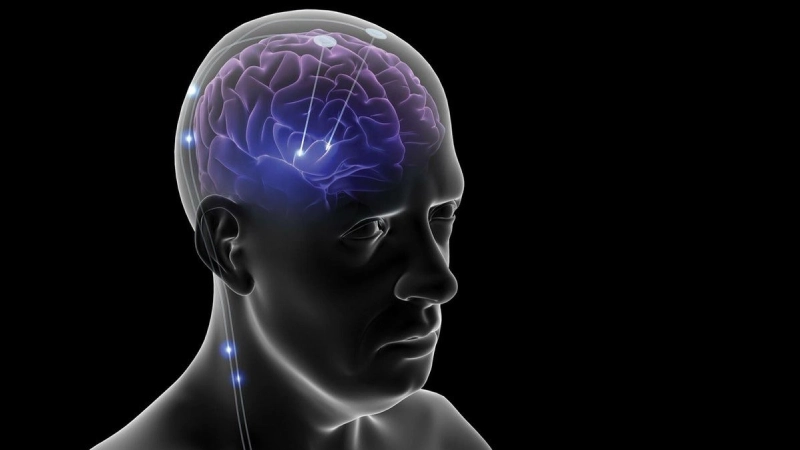 ما هي بطارية الدماغ (التحفيز العميق للدماغ في مرض باركنسون)؟ 13 Beyin Pili P 1