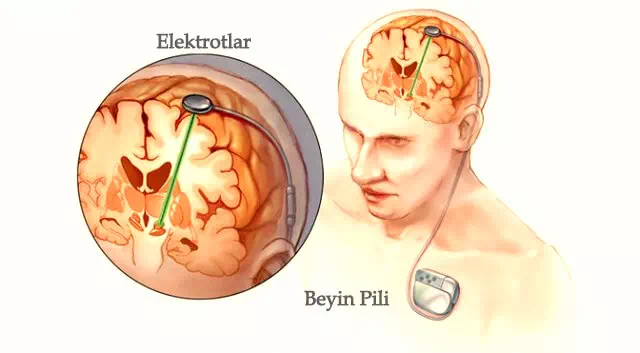 ما هي بطارية الدماغ (التحفيز العميق للدماغ في مرض باركنسون)؟ 3 Beyin Pili