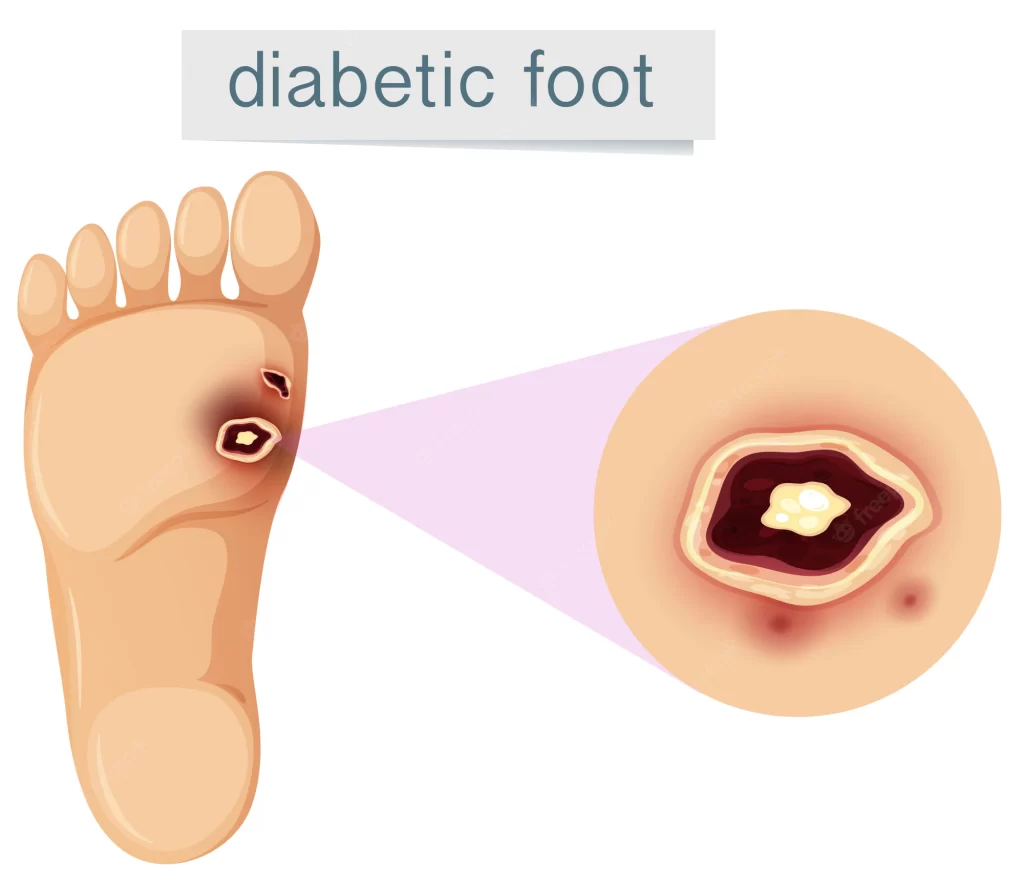 Diyabetik Ayak Yarası 2023 13 Diabetic Foot White Background 1308 15325