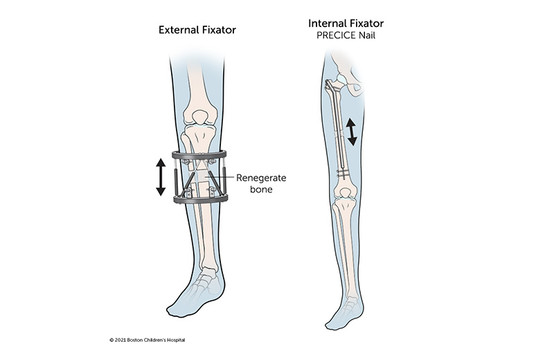 جراحة تطويل القامة 18 Limb Lengthening Leg Devices 1