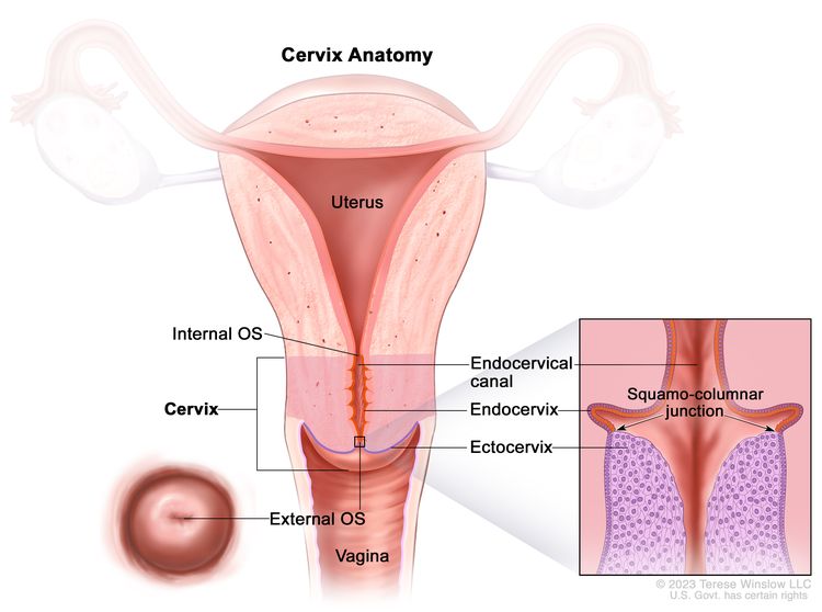 Cervical Cancer 9 810405 750