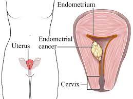 Cervical Cancer 3 Indir 3