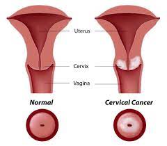Cervical Cancer 11 Indir 4