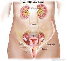Cervical Cancer 7 Indir 5