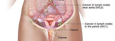 Cervical Cancer 5 Indir 6