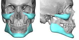 Jaw And Cheekbone Prosthesis 11 Indir