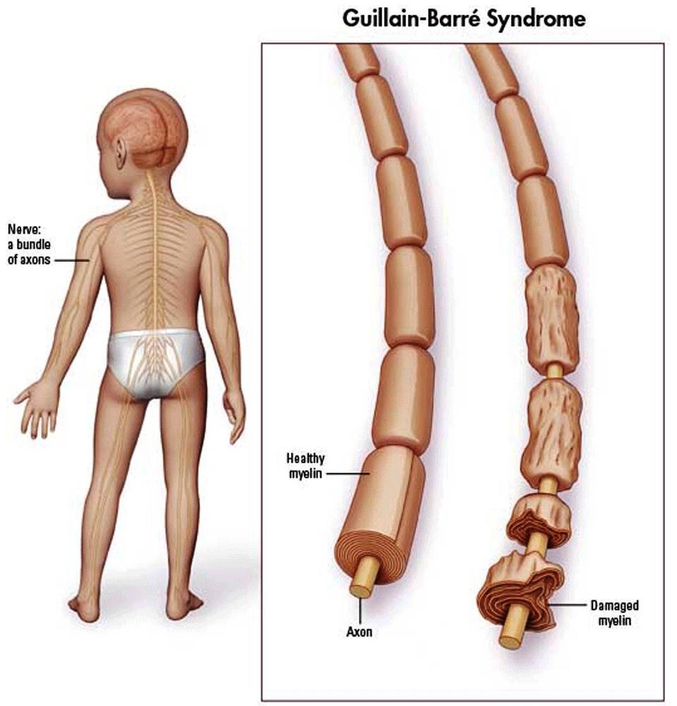 Guillain-Barre Syndrome 4 Guillain Barre Syndrome 1 1