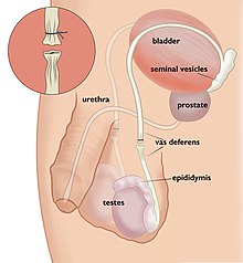 Vasectomy 5 Open Vasectomy 1