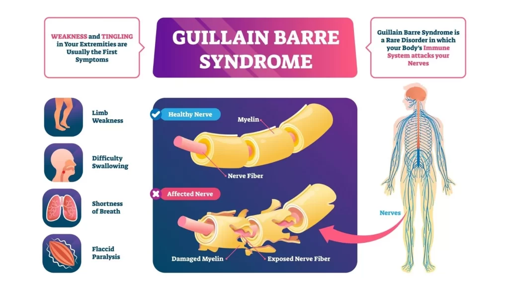 Bu Görselin Alt Özniteliği Boş. Dosya Adı: Guillain-Barre-Syndrome-Treatment-Propel-Physiotherapy-1024X576.Webp