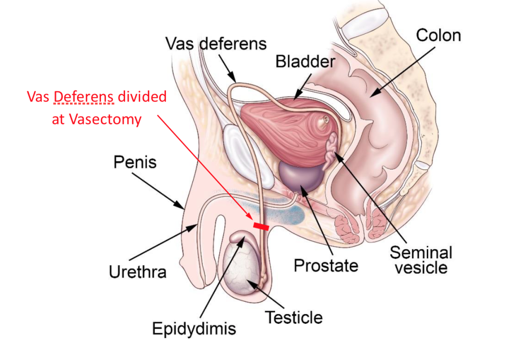 Vasectomy 3 Vasectomy
